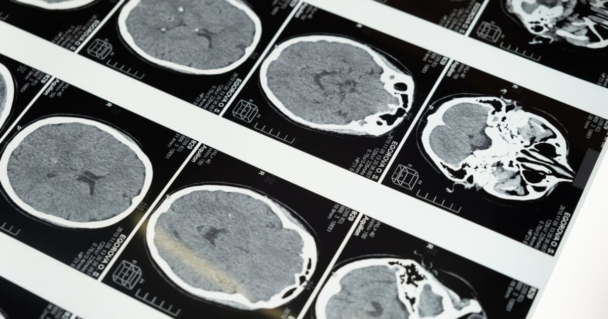 Help for Brain Injury Victims in South Carolina